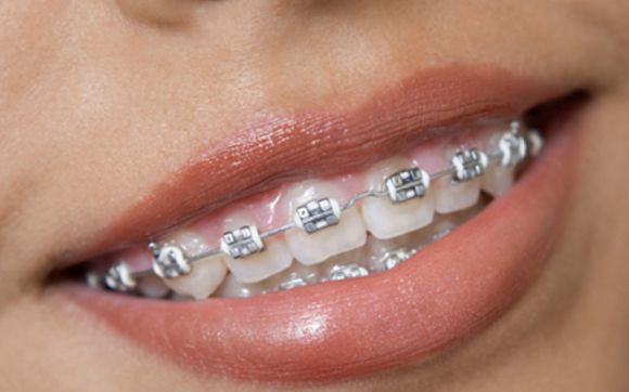 Braces or Invisalign for children and adults. Call 480-865-2848 for details and special offers by Opus 1 Orthodontic Studio