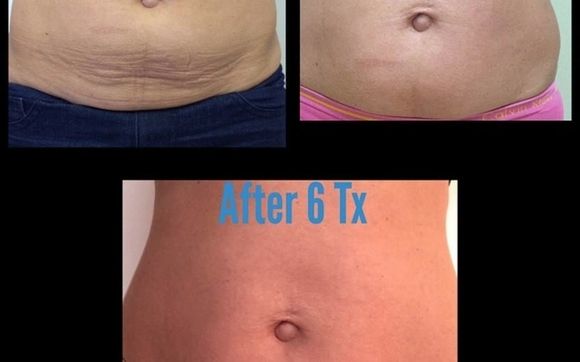 Tummy Tightening (ReFit) & Stretch Mark Reduction by Derma Medical Laser  Clinic in Vancouver, BC - Alignable