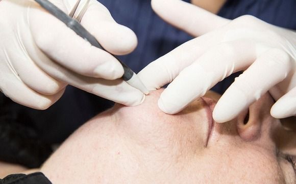 Electrolysis by Superior Skin Care and Electrolysis