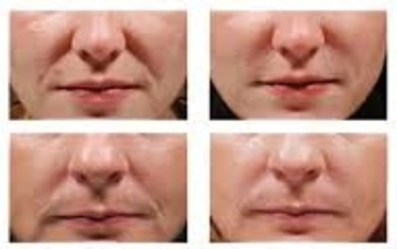 JUVÉDERM VOLUMA® by Natura Plastic Surgery [Dr. Hector Salazar-Reyes]