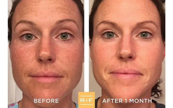 Reverse Regimen for the Appearance of Skin Dullness, Discoloration, and ...