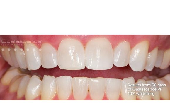 Teeth Whitening by Massey Family Dentistry