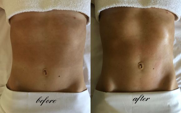 Brazilian Lymphatic Drainage - The Detox Massage  by Just For You Bodywork & Massage