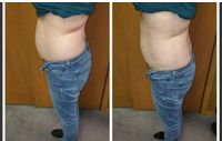 Cavi-Lipo  by Blessings Wellness Center