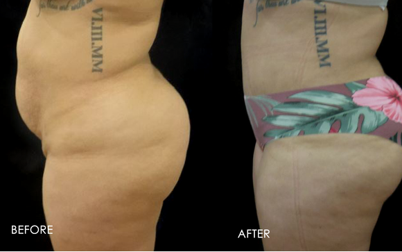 Before & After Liposuction, Fupa Procedure · Rancho Cucamonga, Inland