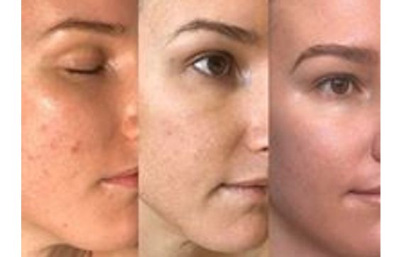 Acne Laser Treatment by Oasis Luxury Med Spa in Pearland, TX - Alignable