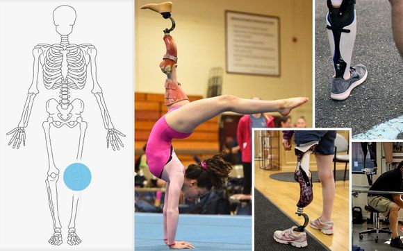 Van Nes Rotationplasty by A Step Ahead Prosthetics in Hicksville, NY ...