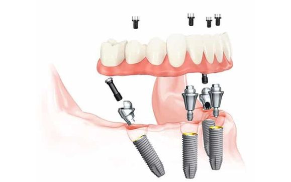 All-on-4: Full Implant Supported Smile Restoration by ARCHPOINT Implant ...