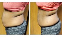 Body Contouring  by Blessings Wellness Center
