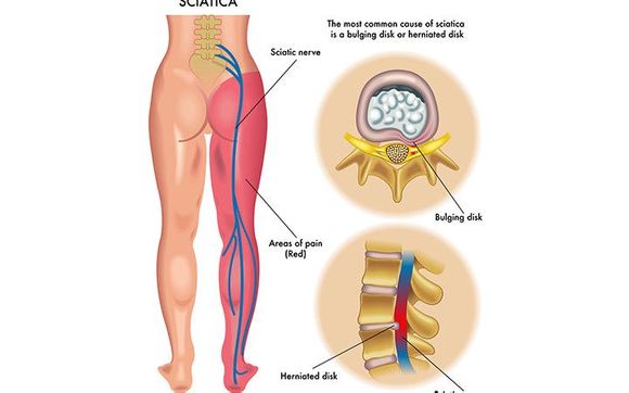 Back Pain and Sciatica Pain by Better Health Solutions LLC