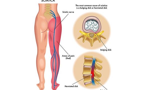 Sciatica Pain or Back Pain by Better Health Solutions LLC