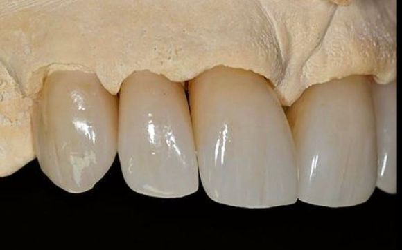 Dental Veneers by J.A.AVOTS LLC