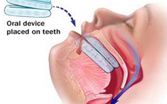 Dental Treatment for Sleep Apnea & Snoring by Dream Systems Dental Sleep Laboratory