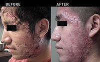 Acne treatments by Healthydermis