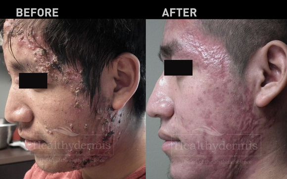 Acne treatments by Healthydermis