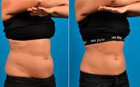 CoolSculpting  by Better Health Medical Group and Day Spa