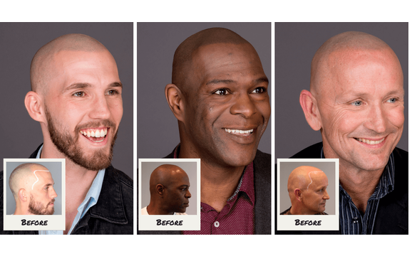Scalp Micropigmentation By Hairline Ink In Austin Tx Alignable