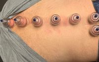 Cupping  by  ProSpine Chiropractic at Spartan Health Solutions