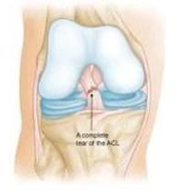 Non Operative Management Partial Stable ACL Tears by Golden State MD 