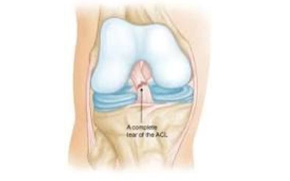 Non Operative Management Partial Stable ACL Tears by Golden State MD 