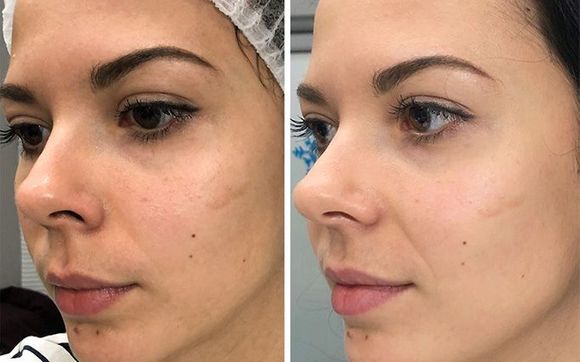 Hydrafacial процедура до и после отзывы Coastal Contours & Wellness - Mobile, AL - Alignable