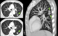 Low dose CT Lung screening by ALFA DIAGNOSTIC