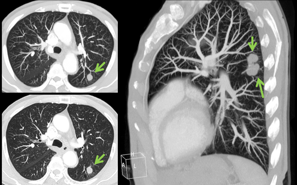 Low Dose CT Lung Screening By ALFA DIAGNOSTIC In Aventura, FL - Alignable