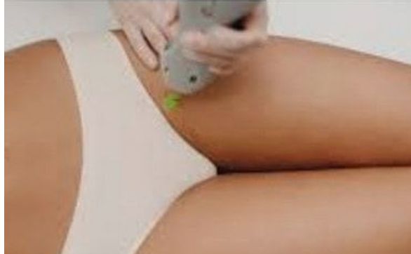 Laser hair removal by The V Spa in Smyrna DE Alignable