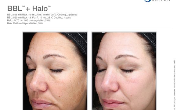 Bbl forever young до и после отзывы Laser Treatments by Face It Botox Bar in Fort Myers, FL - Alignable