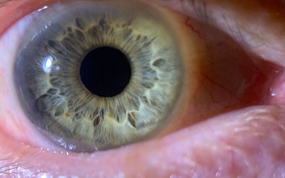 Iridology Reading by Choosing Love Yoga School