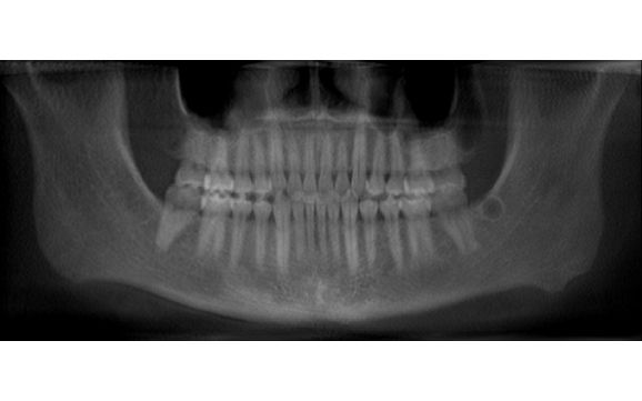 Honolulu tooth implant by Pacific Dental & Implant Solutions