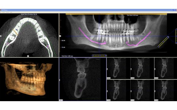 Honolulu prosthodontist by Pacific Dental & Implant Solutions