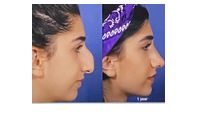 Nasal rhinoplasty by Ear nose throat specialist