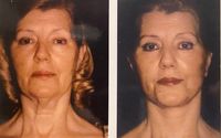 Cosmetic facial surgery  by Ear nose throat specialist