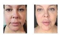 Face Treatments: Anti-Aging & Rejuvenation.  Non-surgical facelift, fat removal, skin tightening.   by Cosmetic Laser Solutions Medical Spa