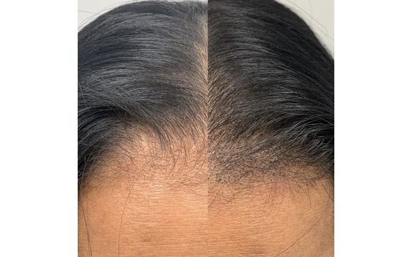 Scalp Micropigmentation For Women (Miami) by Dermesthetica Scalp ...