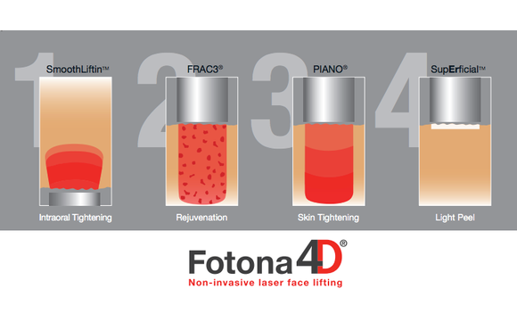 Fotona 4D Laser Face-Lift by Ashtoria Aesthetics & Wellness