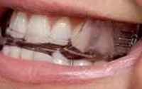 Oral Appliance Therapy for Sleep Apnea and snoring by Cape Cod Sleep Solutions