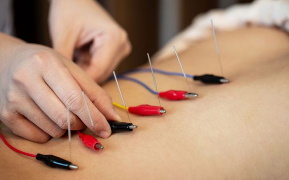 Acupuncture  by Restore Wellness Center