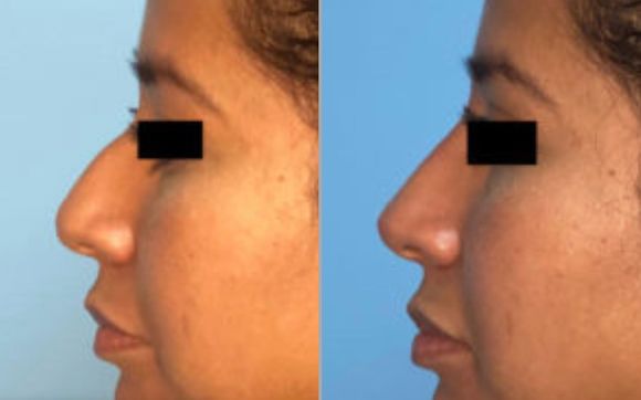 Houston plastic surgery by Houston Plastic Surgery Associates | Christopher Balinger, MD