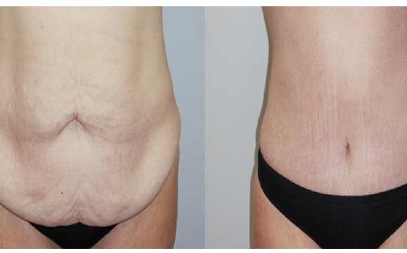 Houston tummy tuck by Houston Plastic Surgery Associates | Christopher Balinger, MD