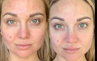Facial Infusions for Wrinkles and Acne by Cosmetic Laser Solutions Medical Spa