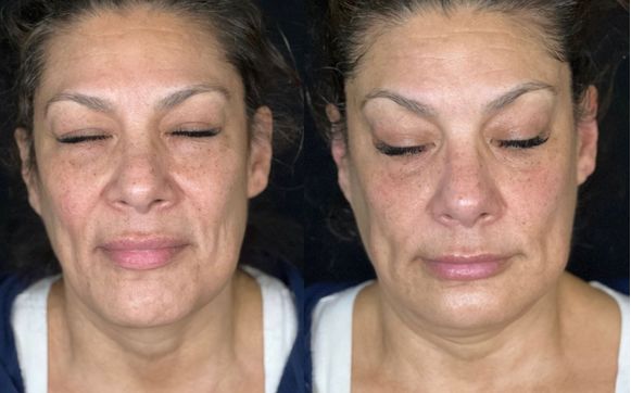 RF Facial by Flawless Beauty By Shilo