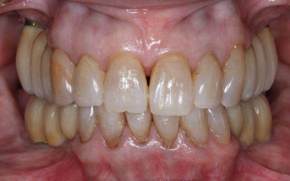 Posterior Implants with custom shade matched crowns by the Portland Dental Laboratory