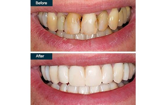 Teeth Whitening in Bronx NY by 505 Dental Associates