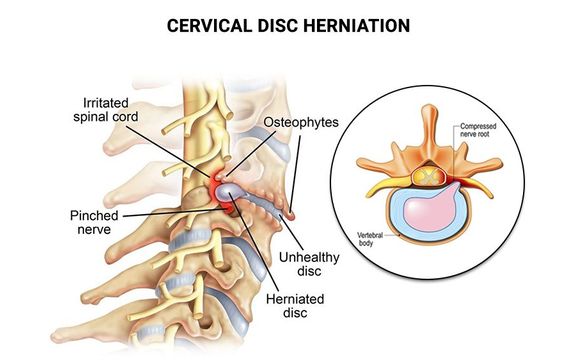 Cervical Herniated Disc Treatment in New Jersey by NU-Spine: Spine Surgery (Brick, NJ)