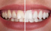 Teeth Whitening by Jordan J. Balvich, DMD, PC