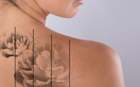 Cutera Enlighten Laser for Tattoo Removal by LMC - Laser Medical Clinic