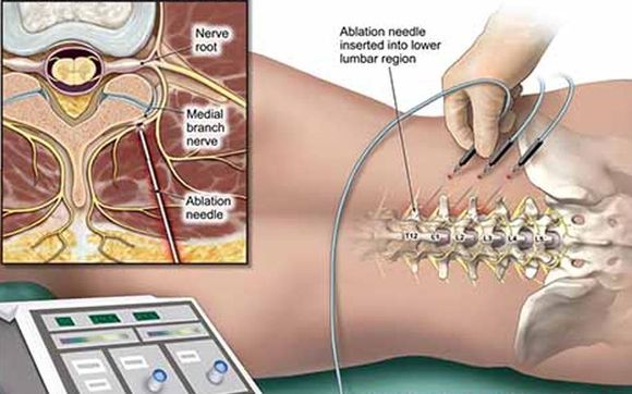 RFA (Radiofrequency Ablation)  by Pain Physicians NY