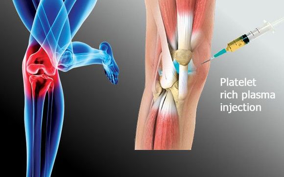 Platelet-Rich-Plasma Injections (PRP) by Pain Physicians NY